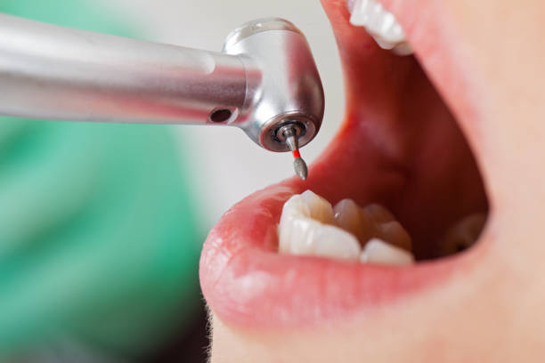 Best Emergency Tooth Extraction in Parma, OH